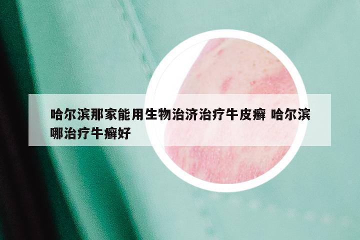 哈尔滨那家能用生物治济治疗牛皮癣 哈尔滨哪治疗牛癣好