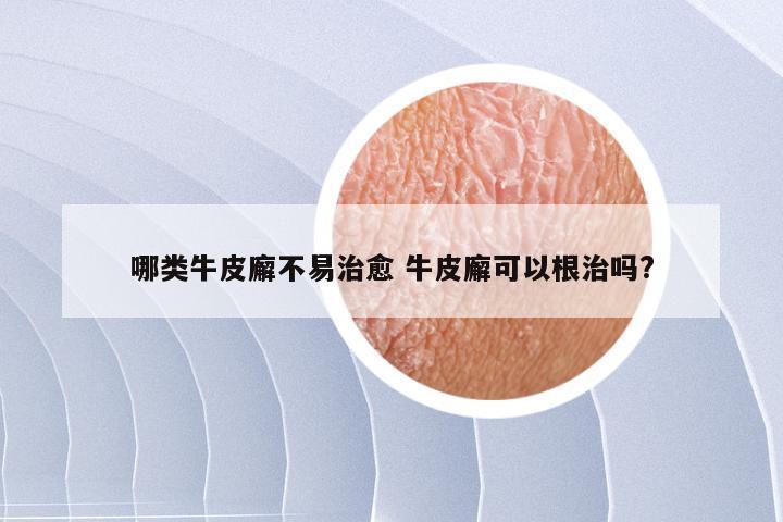 哪类牛皮廨不易治愈 牛皮廨可以根治吗?