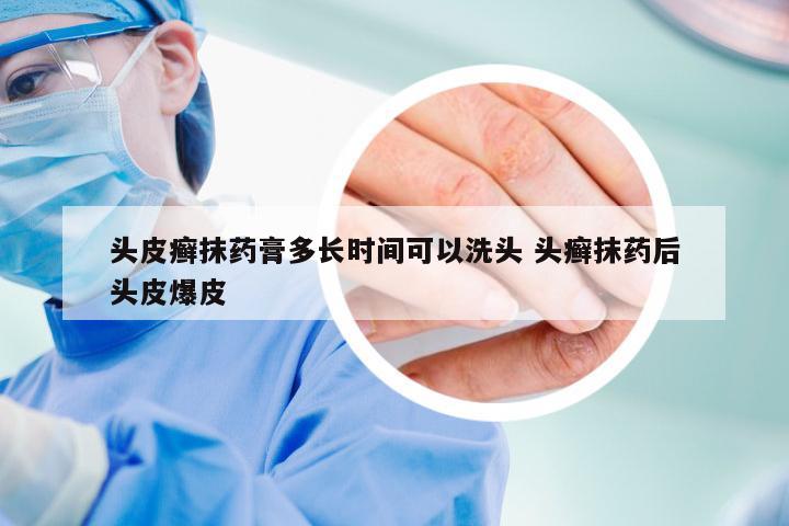 头皮癣抹药膏多长时间可以洗头 头癣抹药后头皮爆皮