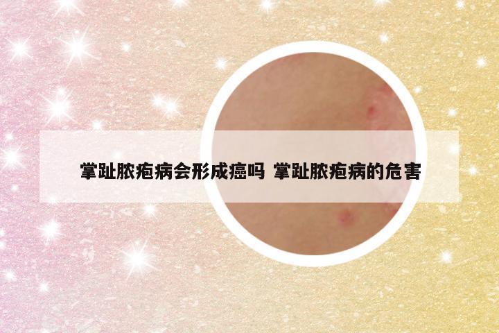 掌趾脓疱病会形成癌吗 掌趾脓疱病的危害