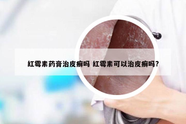 红霉素药膏治皮癣吗 红霉素可以治皮癣吗?