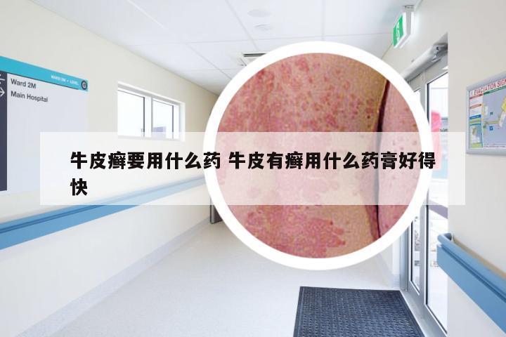 牛皮癣要用什么药 牛皮有癣用什么药膏好得快