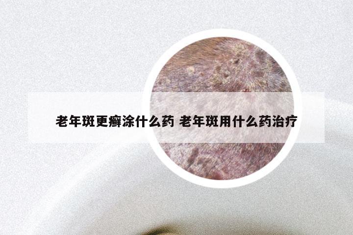 老年斑更癣涂什么药 老年斑用什么药治疗