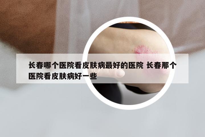 长春哪个医院看皮肤病最好的医院 长春那个医院看皮肤病好一些