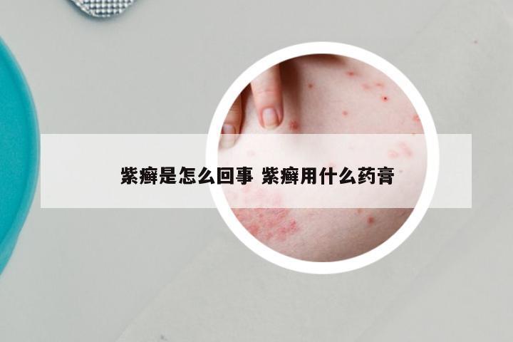 紫癣是怎么回事 紫癣用什么药膏