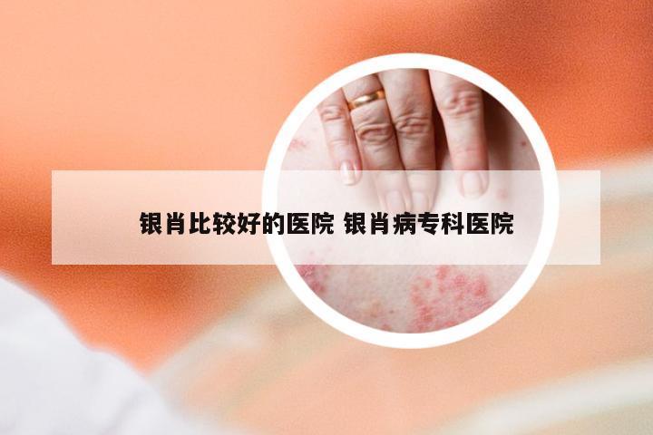 银肖比较好的医院 银肖病专科医院