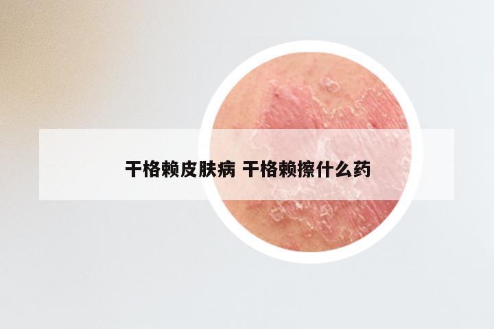 干格赖皮肤病 干格赖擦什么药