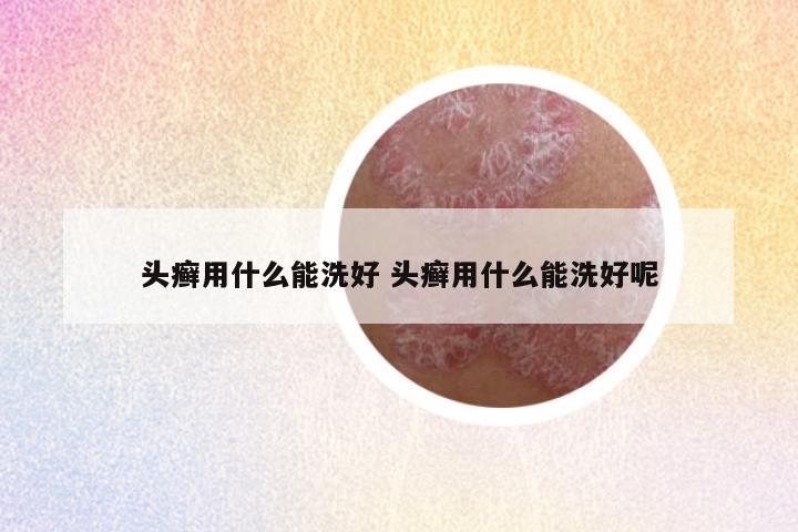 头癣用什么能洗好 头癣用什么能洗好呢