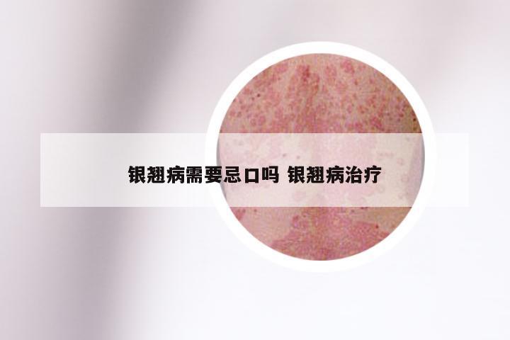 银翘病需要忌口吗 银翘病治疗