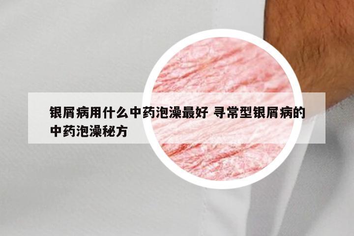 银屑病用什么中药泡澡最好 寻常型银屑病的中药泡澡秘方