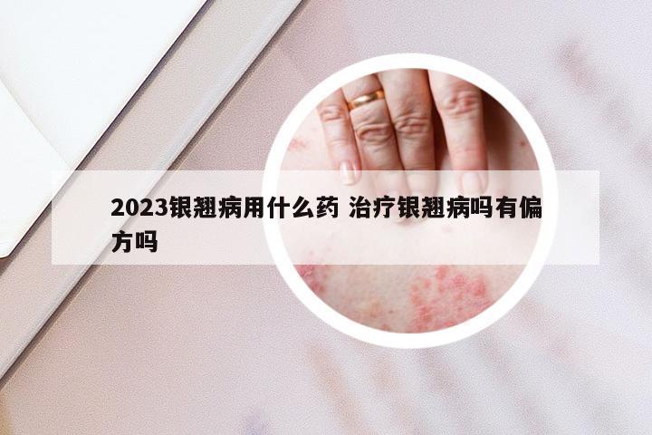 2023银翘病用什么药 治疗银翘病吗有偏方吗