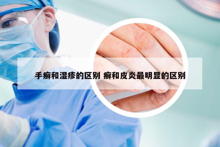 手癣和湿疹的区别 癣和皮炎最明显的区别
