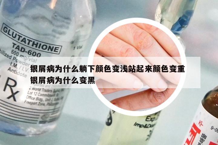 银屑病为什么躺下颜色变浅站起来颜色变重 银屑病为什么变黑