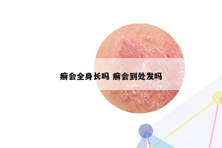 癣会全身长吗 癣会到处发吗