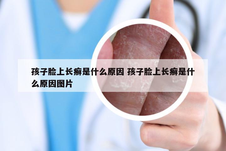 孩子脸上长癣是什么原因 孩子脸上长癣是什么原因图片