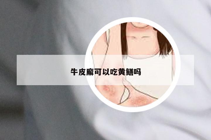 牛皮廨可以吃黄鳝吗