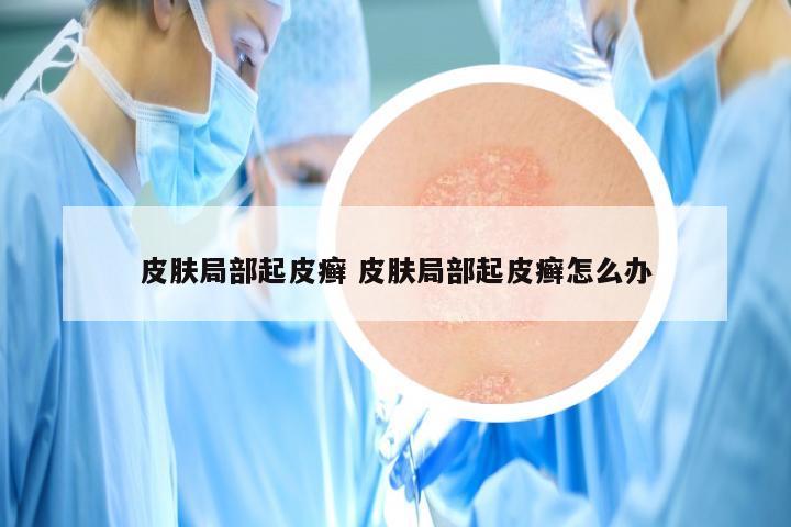 皮肤局部起皮癣 皮肤局部起皮癣怎么办