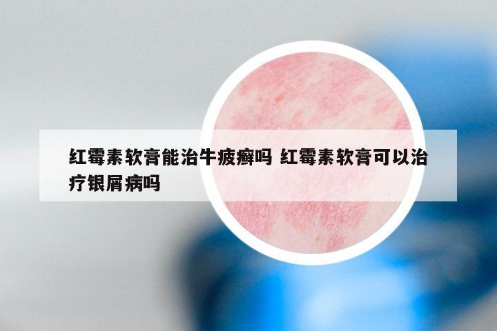 红霉素软膏能治牛疲癣吗 红霉素软膏可以治疗银屑病吗