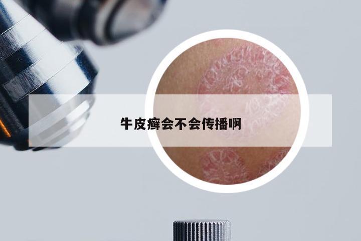 牛皮癣会不会传播啊