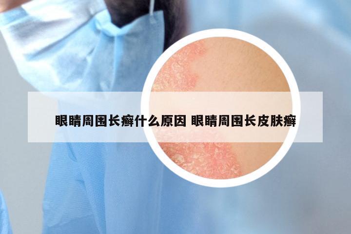 眼睛周围长癣什么原因 眼睛周围长皮肤癣