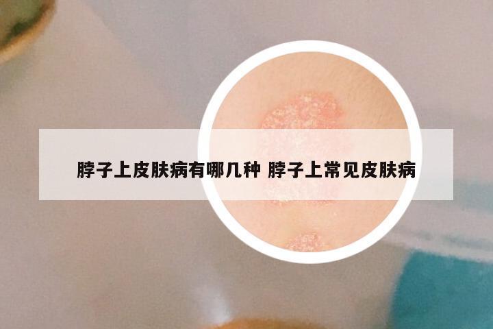 脖子上皮肤病有哪几种 脖子上常见皮肤病