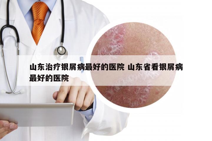 山东治疗银屑病最好的医院 山东省看银屑病最好的医院