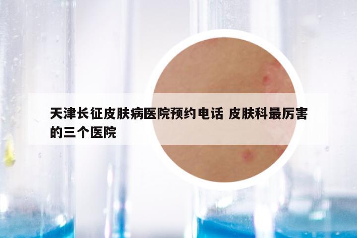 天津长征皮肤病医院预约电话 皮肤科最厉害的三个医院