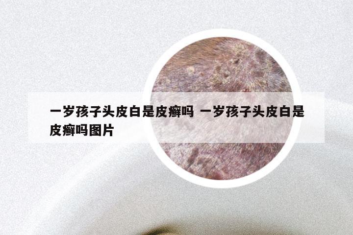 一岁孩子头皮白是皮癣吗 一岁孩子头皮白是皮癣吗图片