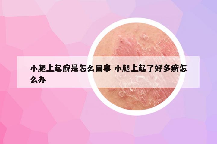 小腿上起癣是怎么回事 小腿上起了好多癣怎么办