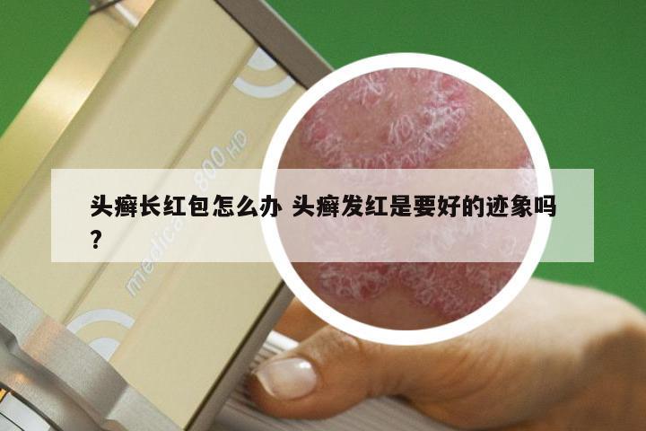 头癣长红包怎么办 头癣发红是要好的迹象吗?