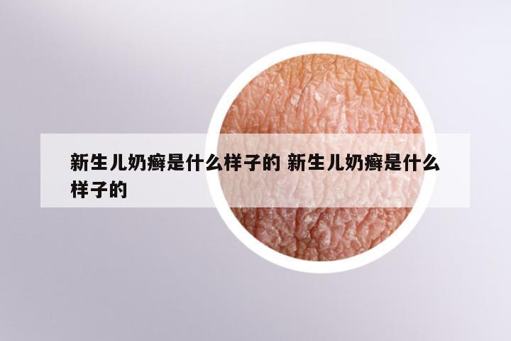 新生儿奶癣是什么样子的 新生儿奶癣是什么样子的