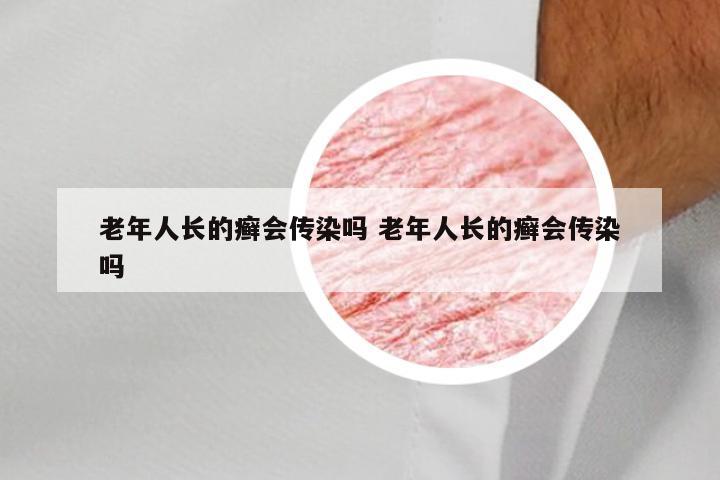 老年人长的癣会传染吗 老年人长的癣会传染吗