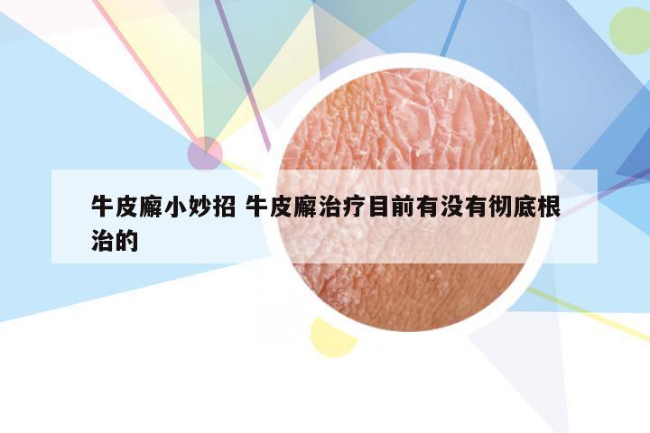 牛皮廨小妙招 牛皮廨治疗目前有没有彻底根治的