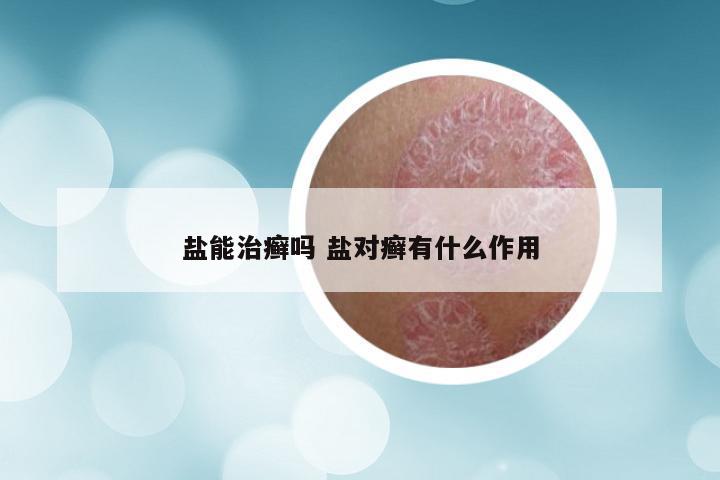 盐能治癣吗 盐对癣有什么作用