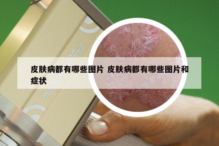 皮肤病都有哪些图片 皮肤病都有哪些图片和症状