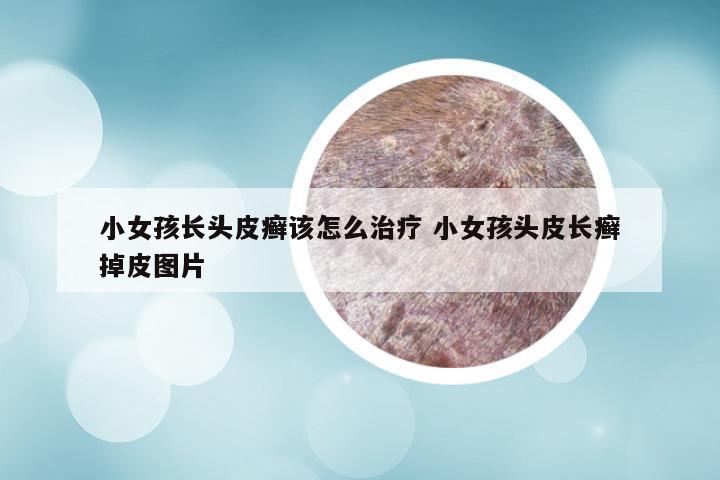 小女孩长头皮癣该怎么治疗 小女孩头皮长癣掉皮图片