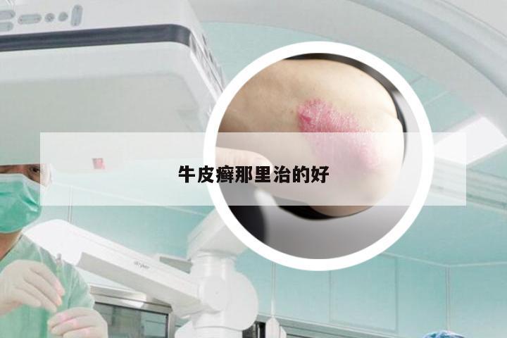 牛皮癣那里治的好
