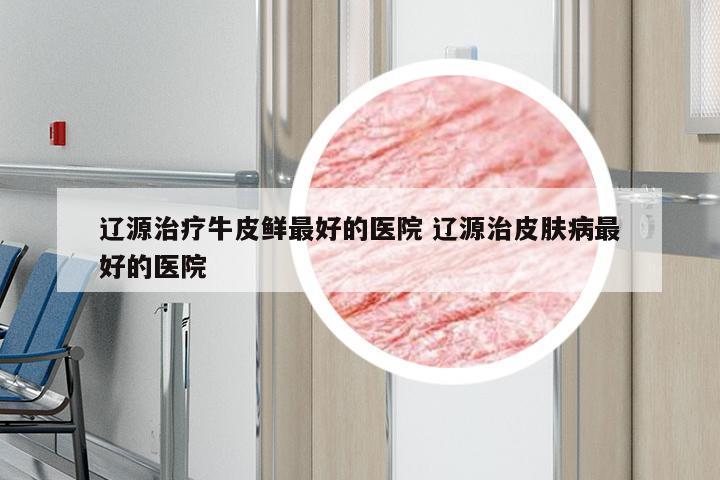 辽源治疗牛皮鲜最好的医院 辽源治皮肤病最好的医院