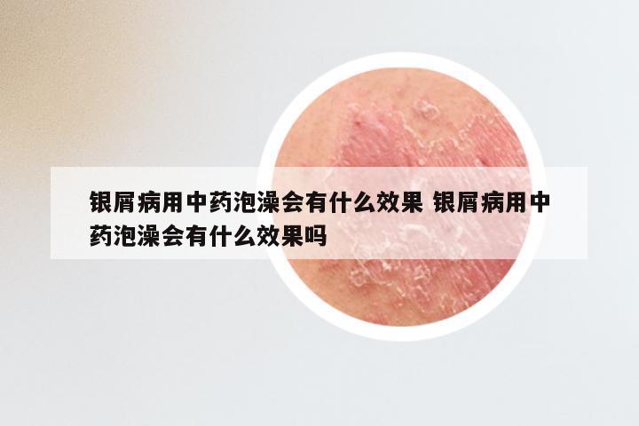 银屑病用中药泡澡会有什么效果 银屑病用中药泡澡会有什么效果吗