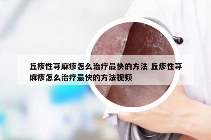丘疹性荨麻疹怎么治疗最快的方法 丘疹性荨麻疹怎么治疗最快的方法视频