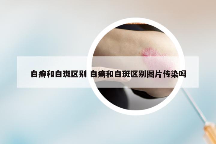白癣和白斑区别 白癣和白斑区别图片传染吗