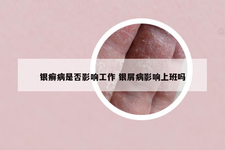 银癣病是否影响工作 银屑病影响上班吗