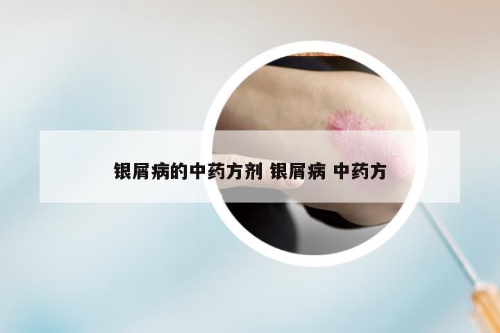 银屑病的中药方剂 银屑病 中药方