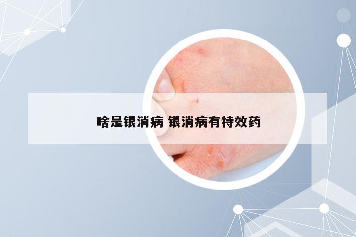啥是银消病 银消病有特效药