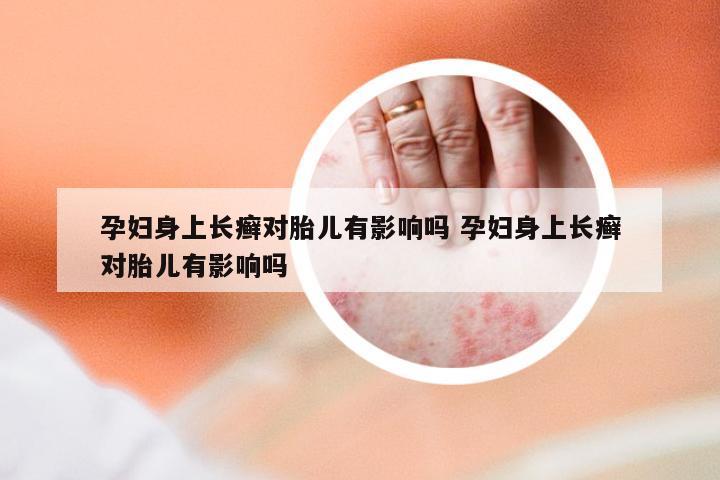 孕妇身上长癣对胎儿有影响吗 孕妇身上长癣对胎儿有影响吗