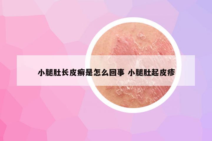 小腿肚长皮癣是怎么回事 小腿肚起皮疹