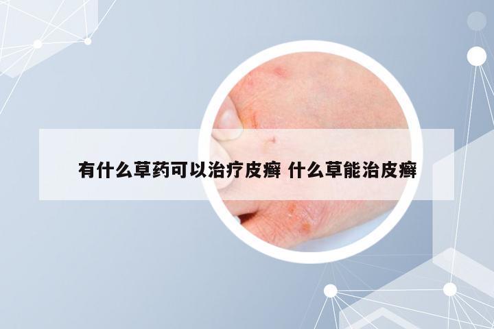有什么草药可以治疗皮癣 什么草能治皮癣
