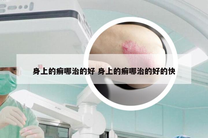 身上的癣哪治的好 身上的癣哪治的好的快