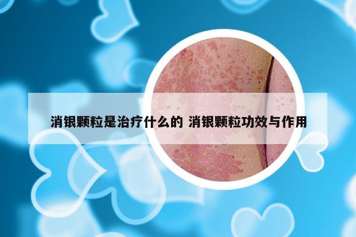 消银颗粒是治疗什么的 消银颗粒功效与作用