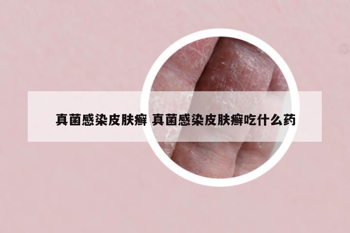 真菌感染皮肤癣 真菌感染皮肤癣吃什么药